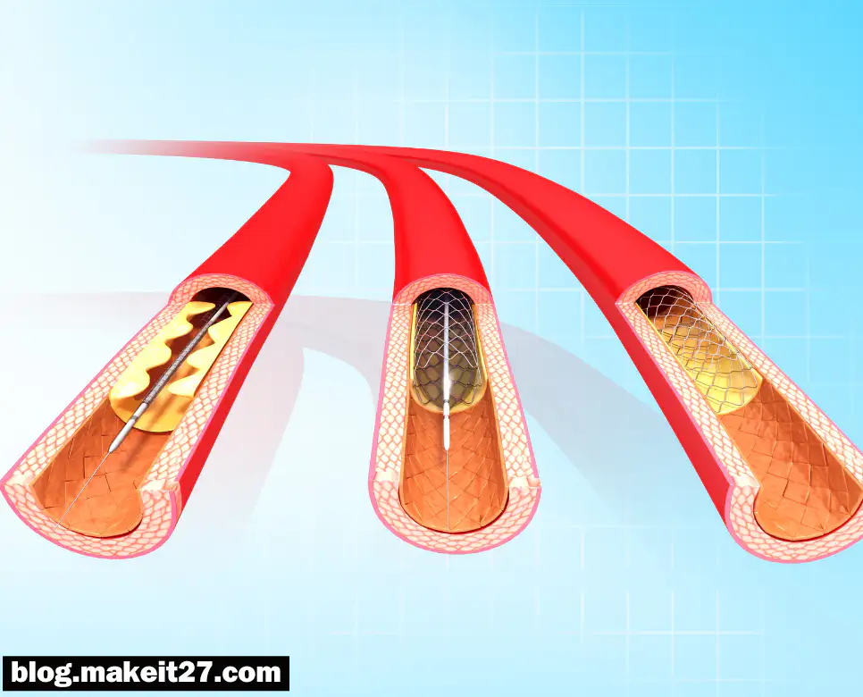의학용어 PCI, PTA, CVAT