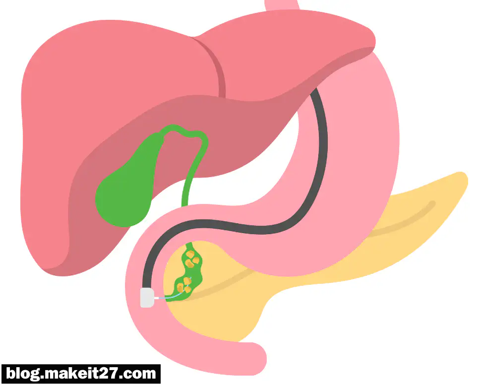의학용어 PTBD, ROSC, F/U