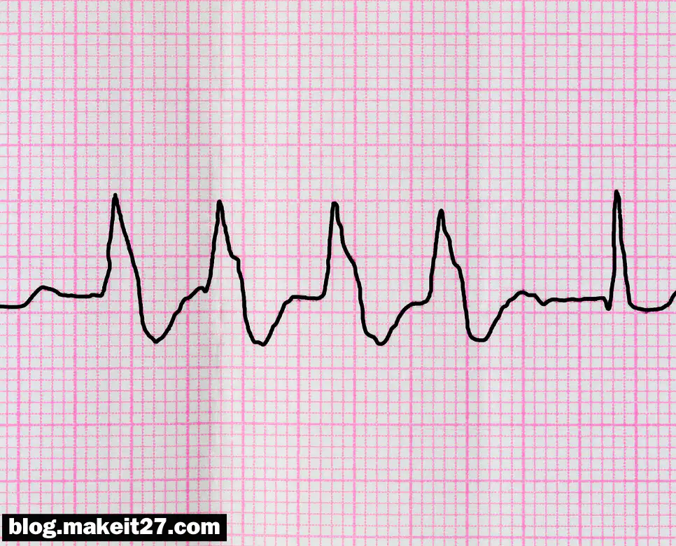 의학용어 RVR, RFCA, RLL