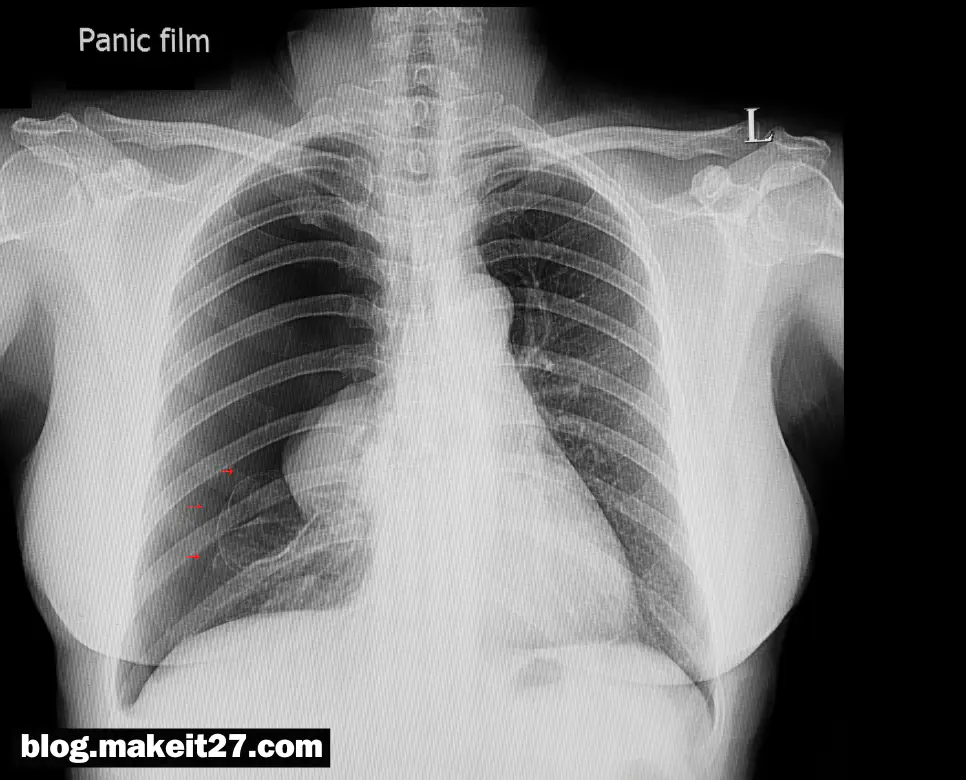 기흉 뜻, 통풍 뜻, 요실금 뜻: 지금 바로 확인하세요!